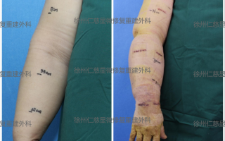 水肿科技 水肿密码破译：同步肿胀的上肢和大腿